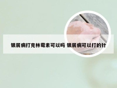 银屑病打克林霉素可以吗 银屑病可以打的针