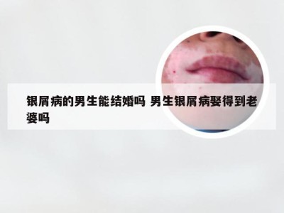 银屑病的男生能结婚吗 男生银屑病娶得到老婆吗