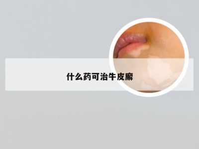 什么药可治牛皮廨