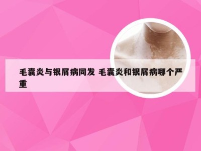 毛囊炎与银屑病同发 毛囊炎和银屑病哪个严重