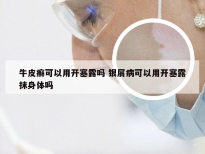 牛皮癣可以用开塞露吗 银屑病可以用开塞露抹身体吗