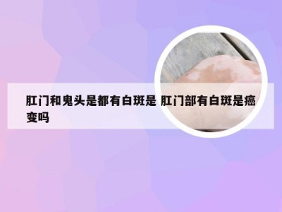 肛门和鬼头是都有白斑是 肛门部有白斑是癌变吗