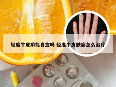 轻度牛皮癣能自愈吗 轻度牛皮肤癣怎么治疗