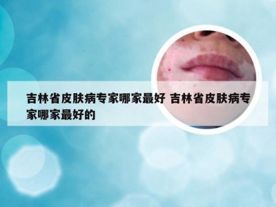 吉林省皮肤病专家哪家最好 吉林省皮肤病专家哪家最好的