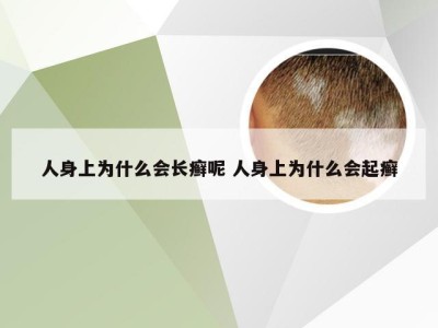 人身上为什么会长癣呢 人身上为什么会起癣