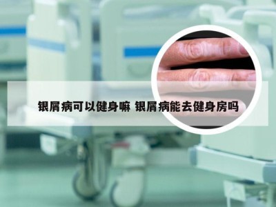 银屑病可以健身嘛 银屑病能去健身房吗