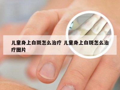 儿童身上白斑怎么治疗 儿童身上白斑怎么治疗图片