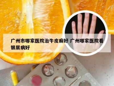 广州市哪家医院治牛皮癣好 广州哪家医院看银屑病好