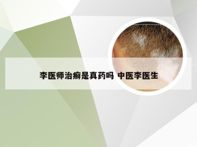 李医师治癣是真药吗 中医李医生