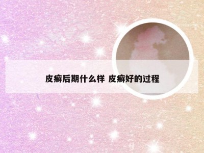 皮癣后期什么样 皮癣好的过程