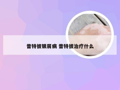 普特彼银屑病 普特彼治疗什么