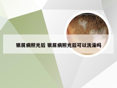 银屑病照光后 银屑病照光后可以洗澡吗