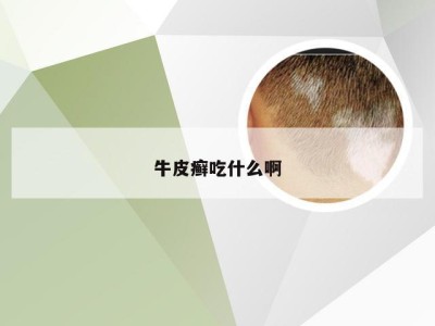 牛皮癣吃什么啊