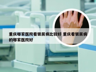 重庆哪家医院看银屑病比较好 重庆看银屑病的哪家医院好