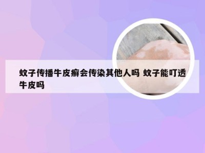 蚊子传播牛皮癣会传染其他人吗 蚊子能叮透牛皮吗