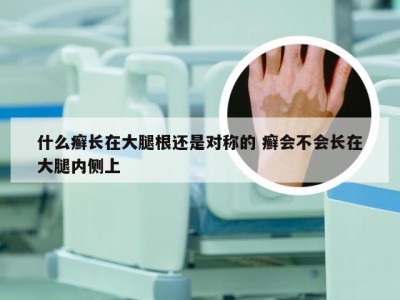 什么癣长在大腿根还是对称的 癣会不会长在大腿内侧上