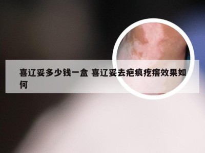 喜辽妥多少钱一盒 喜辽妥去疤痕疙瘩效果如何