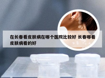 在长春看皮肤病在哪个医院比较好 长春哪看皮肤病看的好