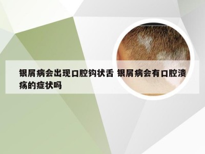 银屑病会出现口腔钩状舌 银屑病会有口腔溃疡的症状吗