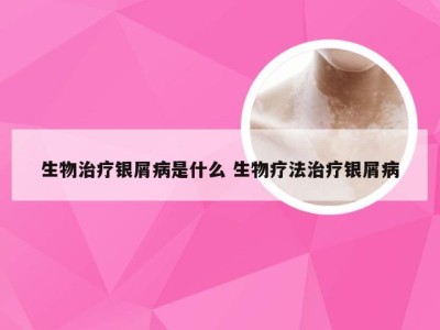 生物治疗银屑病是什么 生物疗法治疗银屑病