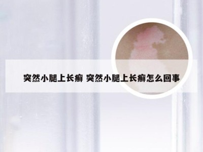 突然小腿上长癣 突然小腿上长癣怎么回事