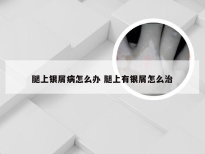 腿上银屑病怎么办 腿上有银屑怎么治