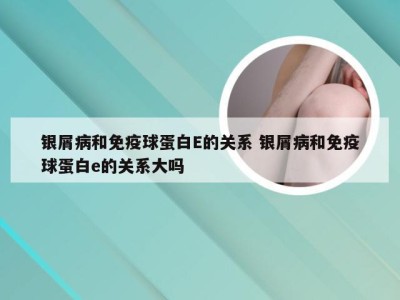 银屑病和免疫球蛋白E的关系 银屑病和免疫球蛋白e的关系大吗