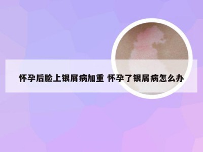 怀孕后脸上银屑病加重 怀孕了银屑病怎么办