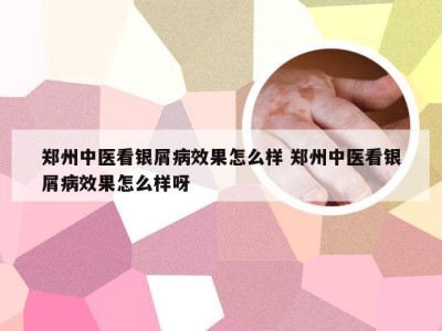 郑州中医看银屑病效果怎么样 郑州中医看银屑病效果怎么样呀