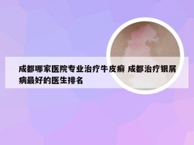 成都哪家医院专业治疗牛皮癣 成都治疗银屑病最好的医生排名