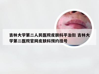 吉林大学第二人民医院皮肤科平治街 吉林大学第二医院官网皮肤科预约挂号