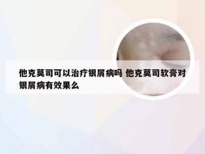 他克莫司可以治疗银屑病吗 他克莫司软膏对银屑病有效果么