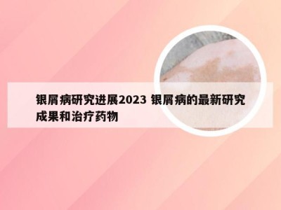 银屑病研究进展2023 银屑病的最新研究成果和治疗药物