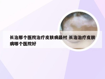 长治那个医院治疗皮肤病最村 长治治疗皮肤病哪个医院好