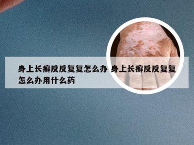 身上长癣反反复复怎么办 身上长癣反反复复怎么办用什么药