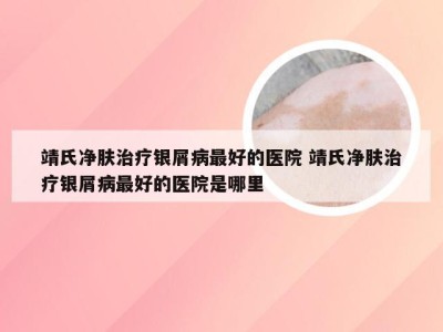 靖氏净肤治疗银屑病最好的医院 靖氏净肤治疗银屑病最好的医院是哪里