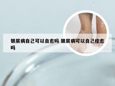 银屑病自己可以自愈吗 银屑病可以自己痊愈吗