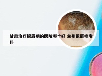 甘肃治疗银屑病的医院哪个好 兰州银屑病专科