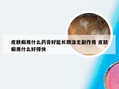 皮肤癣用什么药膏好能长期涂无副作用 皮肤癣用什么好得快