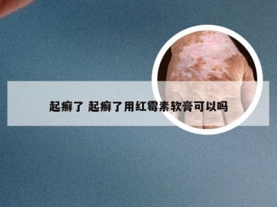 起癣了 起癣了用红霉素软膏可以吗