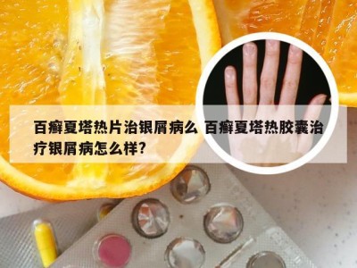 百癣夏塔热片治银屑病么 百癣夏塔热胶囊治疗银屑病怎么样?