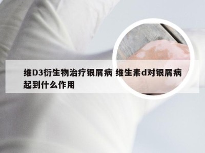 维D3衍生物治疗银屑病 维生素d对银屑病起到什么作用