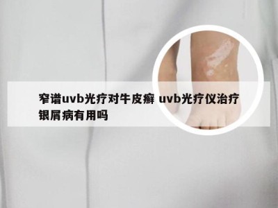 窄谱uvb光疗对牛皮癣 uvb光疗仪治疗银屑病有用吗