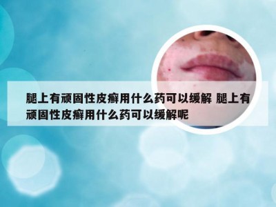 腿上有顽固性皮癣用什么药可以缓解 腿上有顽固性皮癣用什么药可以缓解呢