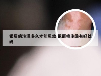 银屑病泡澡多久才能见效 银屑病泡澡有好处吗