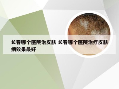 长春哪个医院治皮肤 长春哪个医院治疗皮肤病效果最好