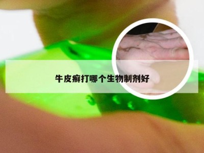 牛皮癣打哪个生物制剂好