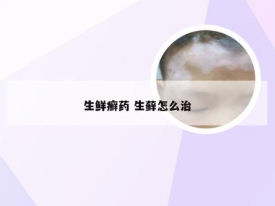 生鲜癣药 生藓怎么治