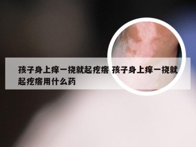 孩子身上痒一挠就起疙瘩 孩子身上痒一挠就起疙瘩用什么药