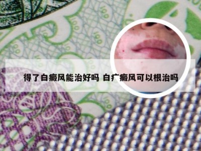 得了白癜风能治好吗 白疒癜风可以根治吗